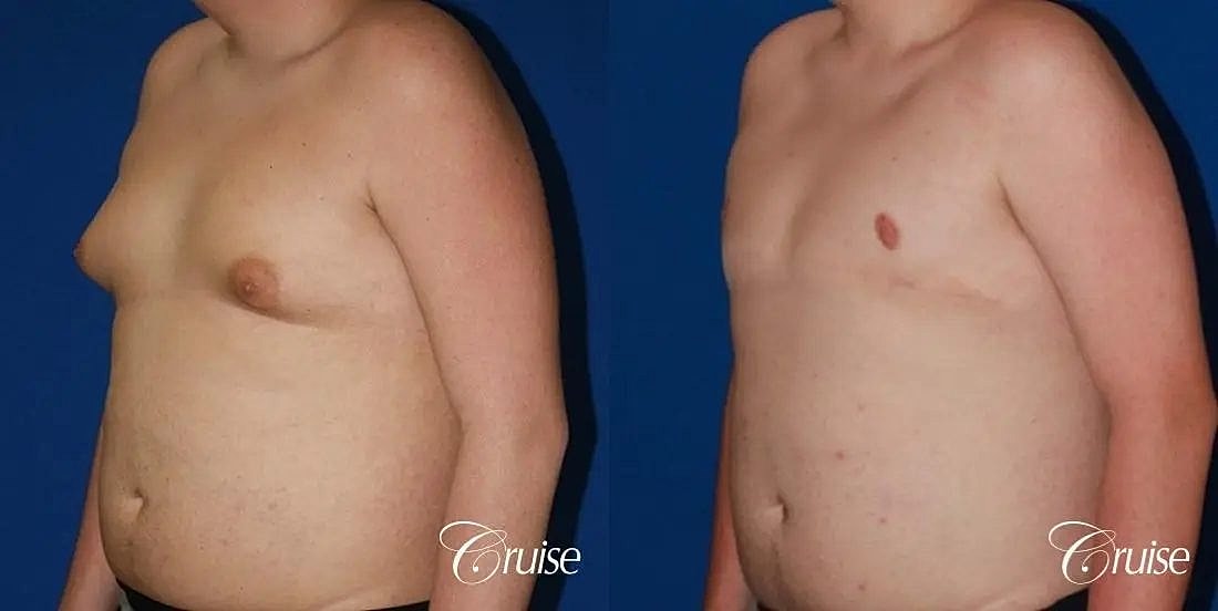 Gynecomastia Surgery Before & After