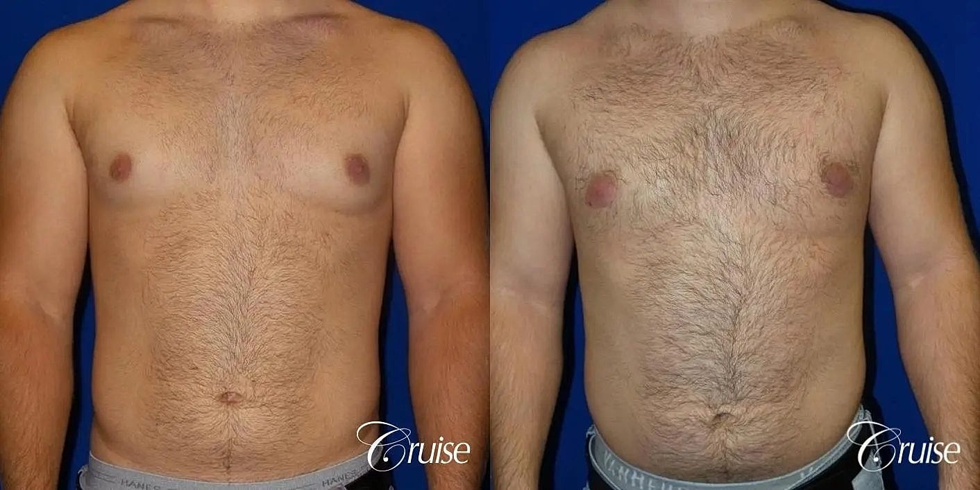 Gynecomastia Surgery Before & After