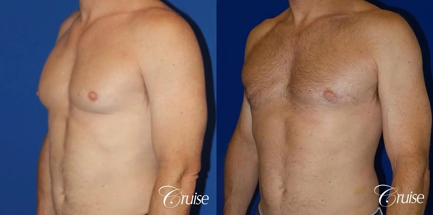 Gynecomastia Surgery Before & After