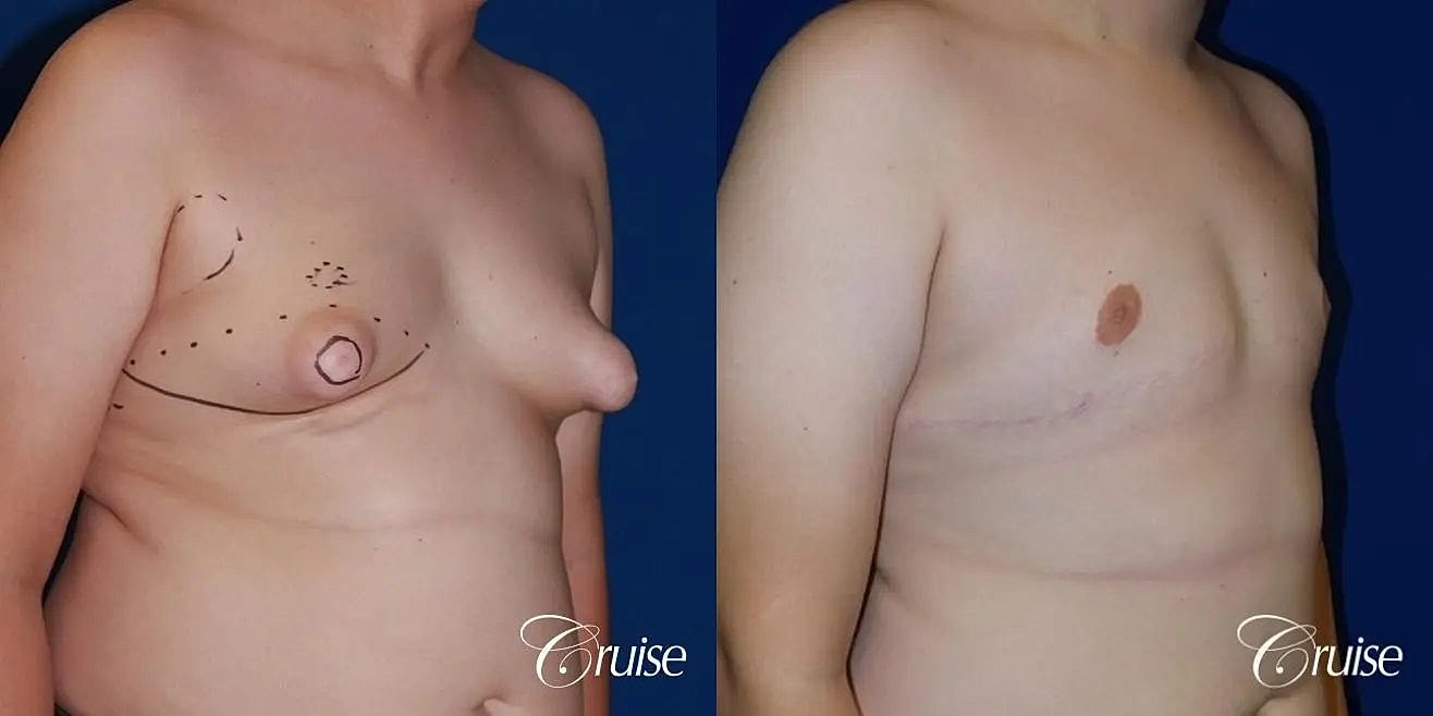 Gynecomastia Surgery Before & After