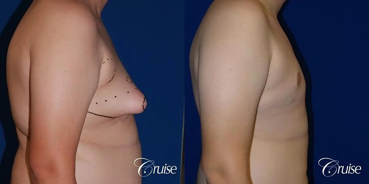 Gynecomastia Surgery Before & After