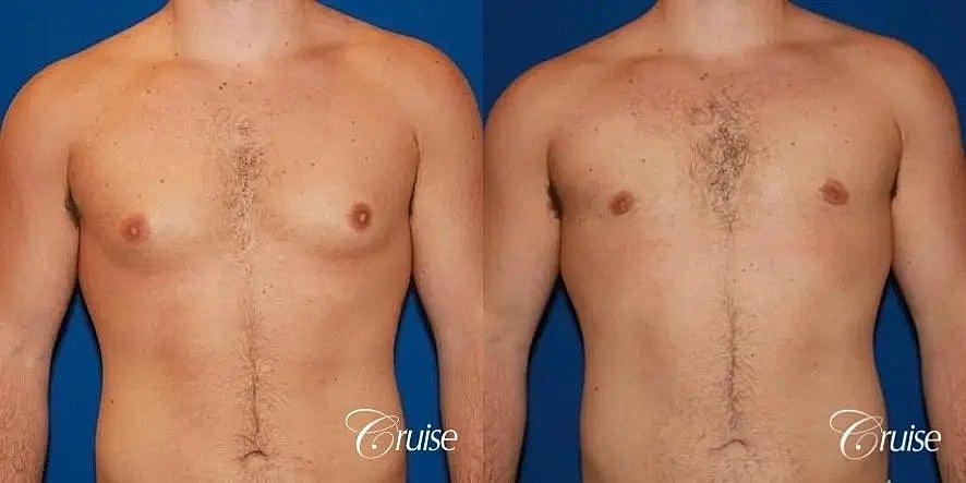 Gynecomastia Surgery Before & After
