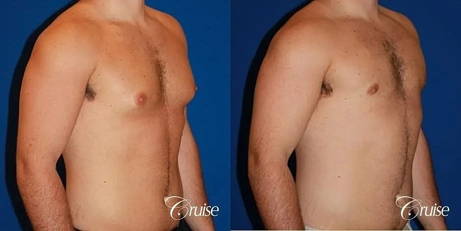 Gynecomastia Surgery Before & After
