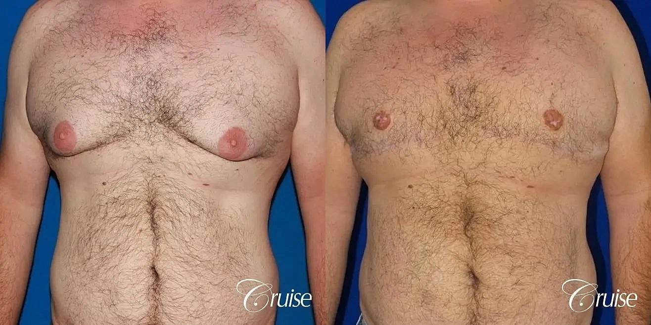 Gynecomastia Surgery Before & After