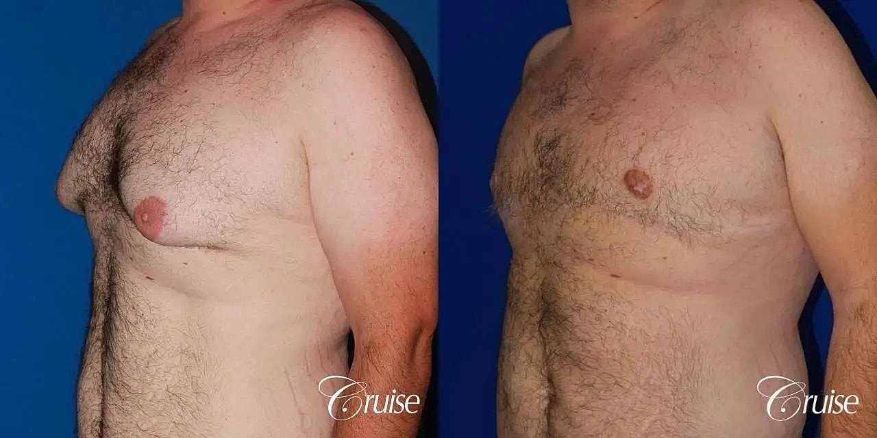Gynecomastia Surgery Before & After