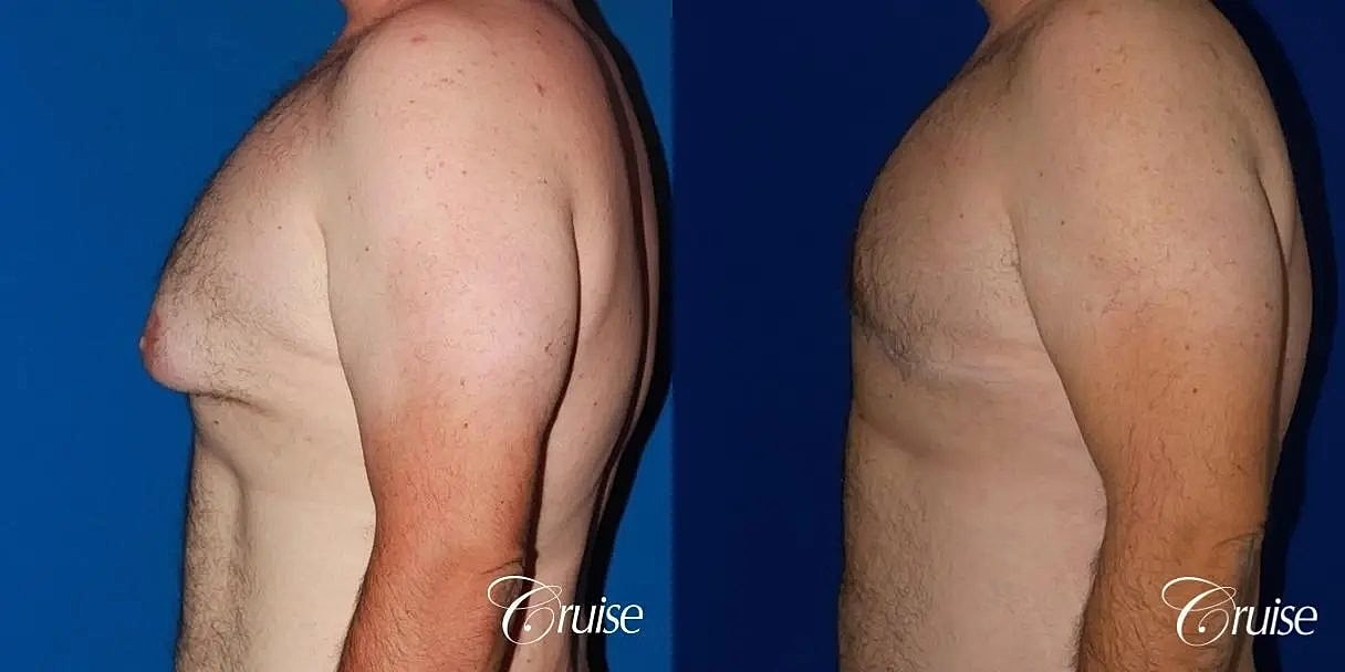 Gynecomastia Surgery Before & After