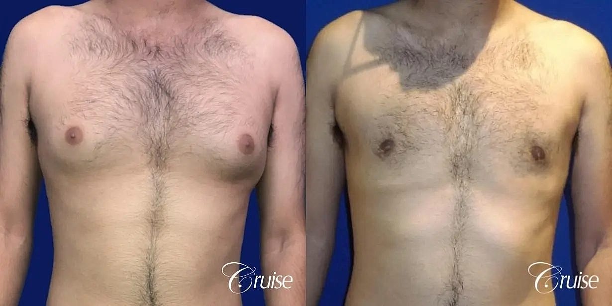 Gynecomastia Surgery Before & After