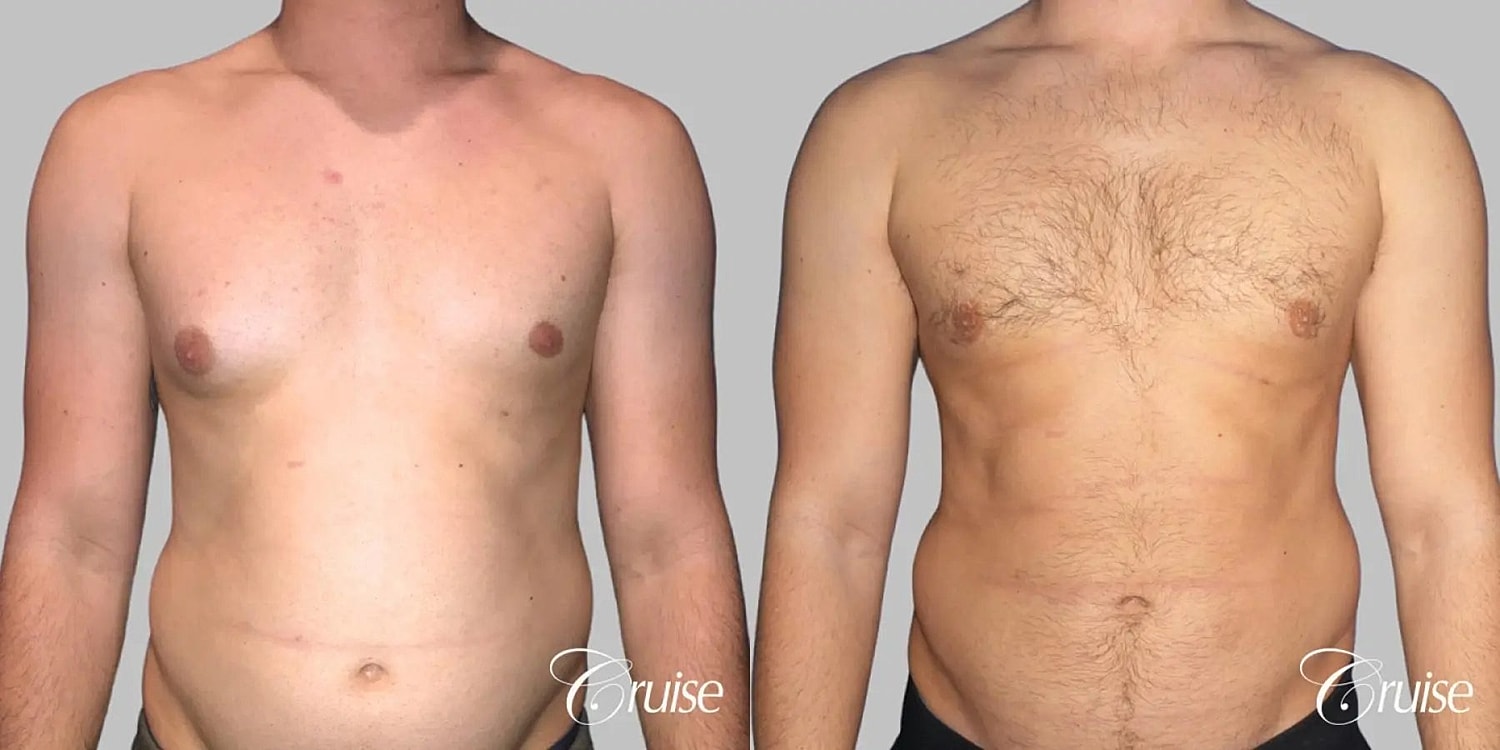 Gynecomastia Surgery Before & After