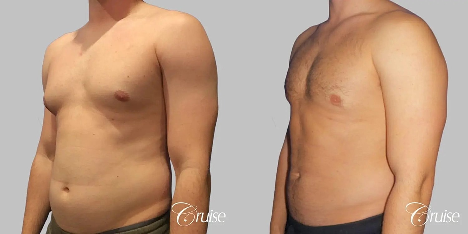 Gynecomastia Surgery Before & After
