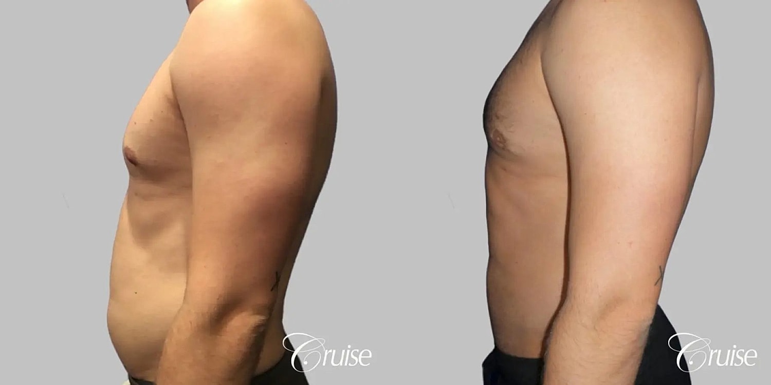 Gynecomastia Surgery Before & After
