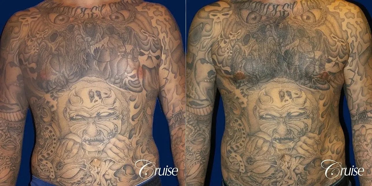 Gynecomastia Surgery Before & After