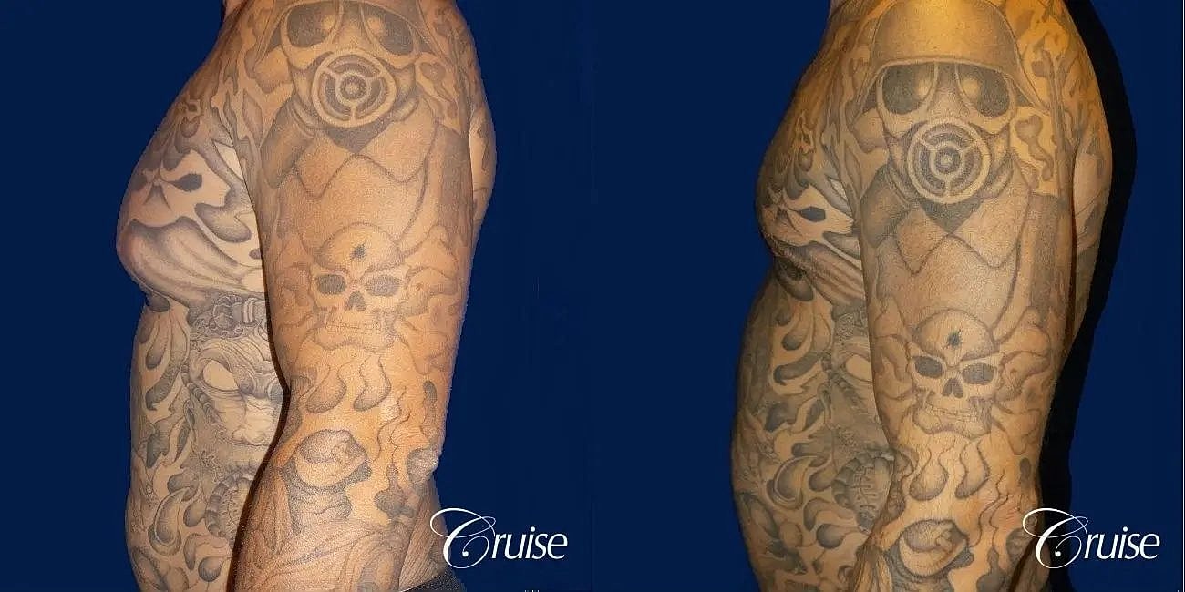 Gynecomastia Surgery Before & After