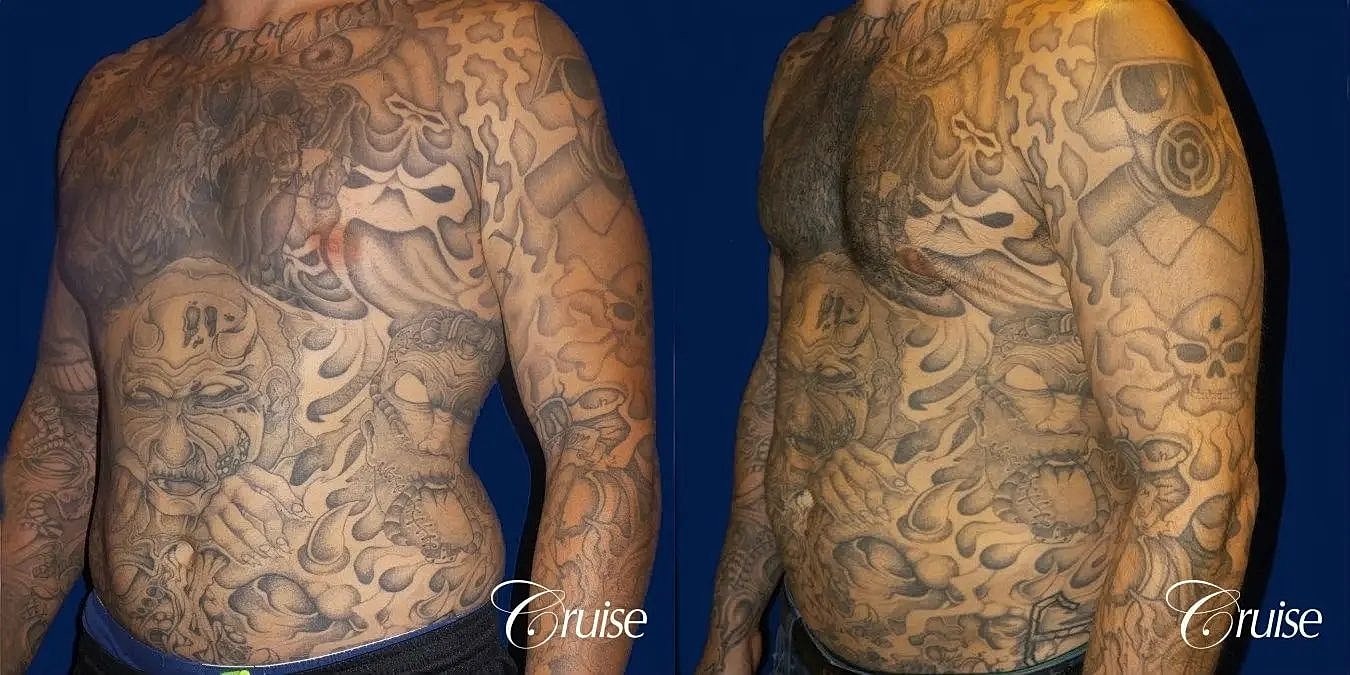 Gynecomastia Surgery Before & After