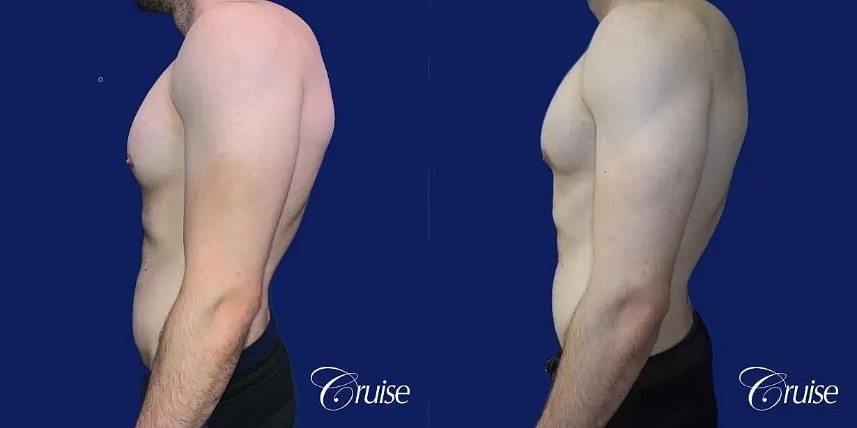 Gynecomastia Surgery Before & After