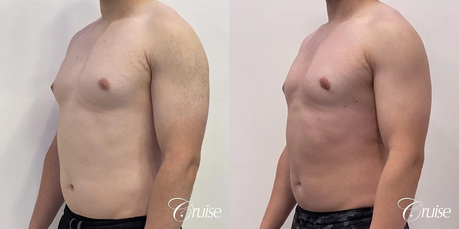 Gynecomastia Surgery Before & After