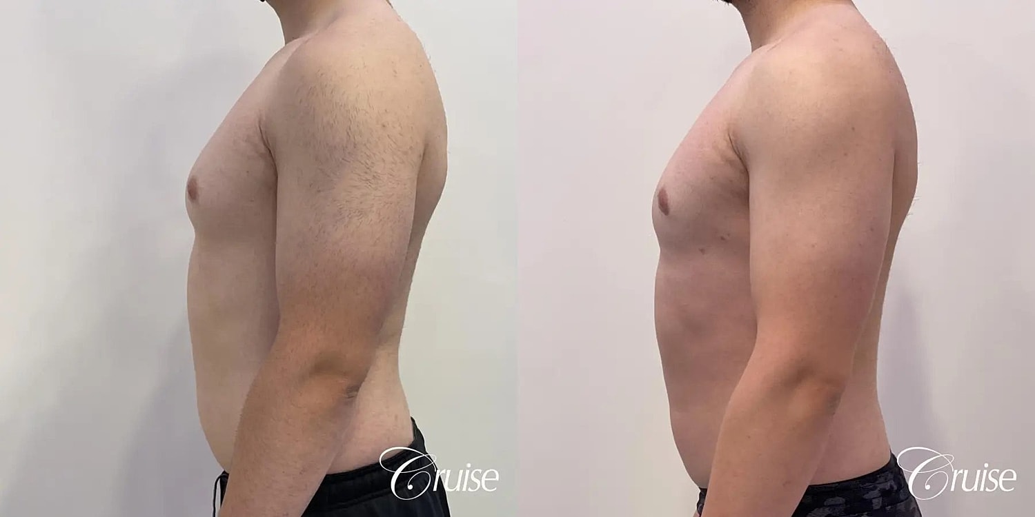Gynecomastia Surgery Before & After