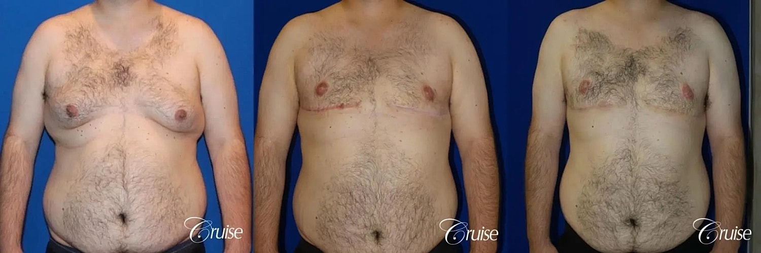 Gynecomastia Surgery Before & After
