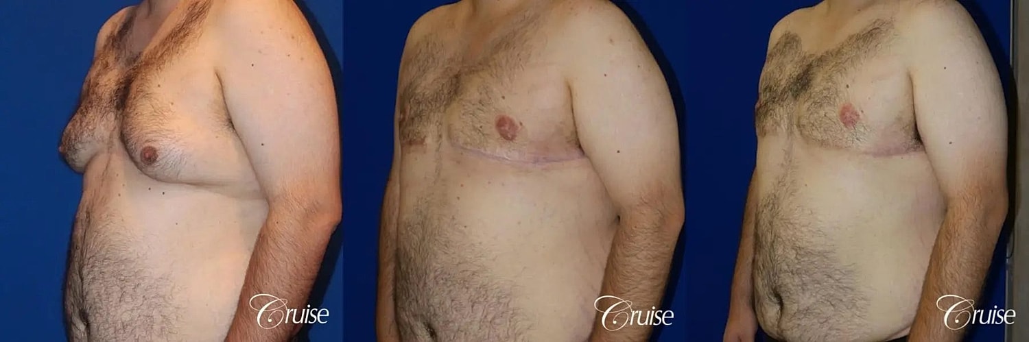 Gynecomastia Surgery Before & After