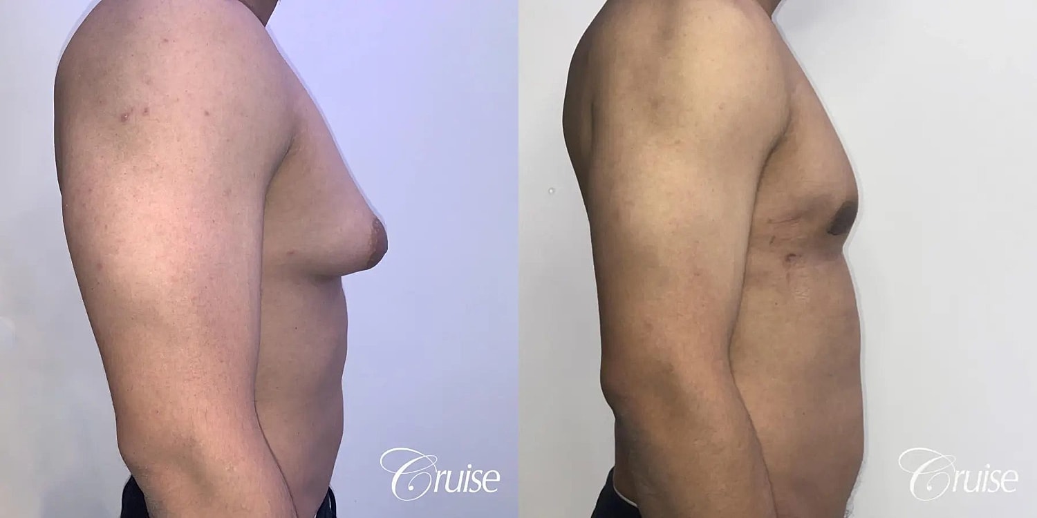 Gynecomastia Surgery Before & After