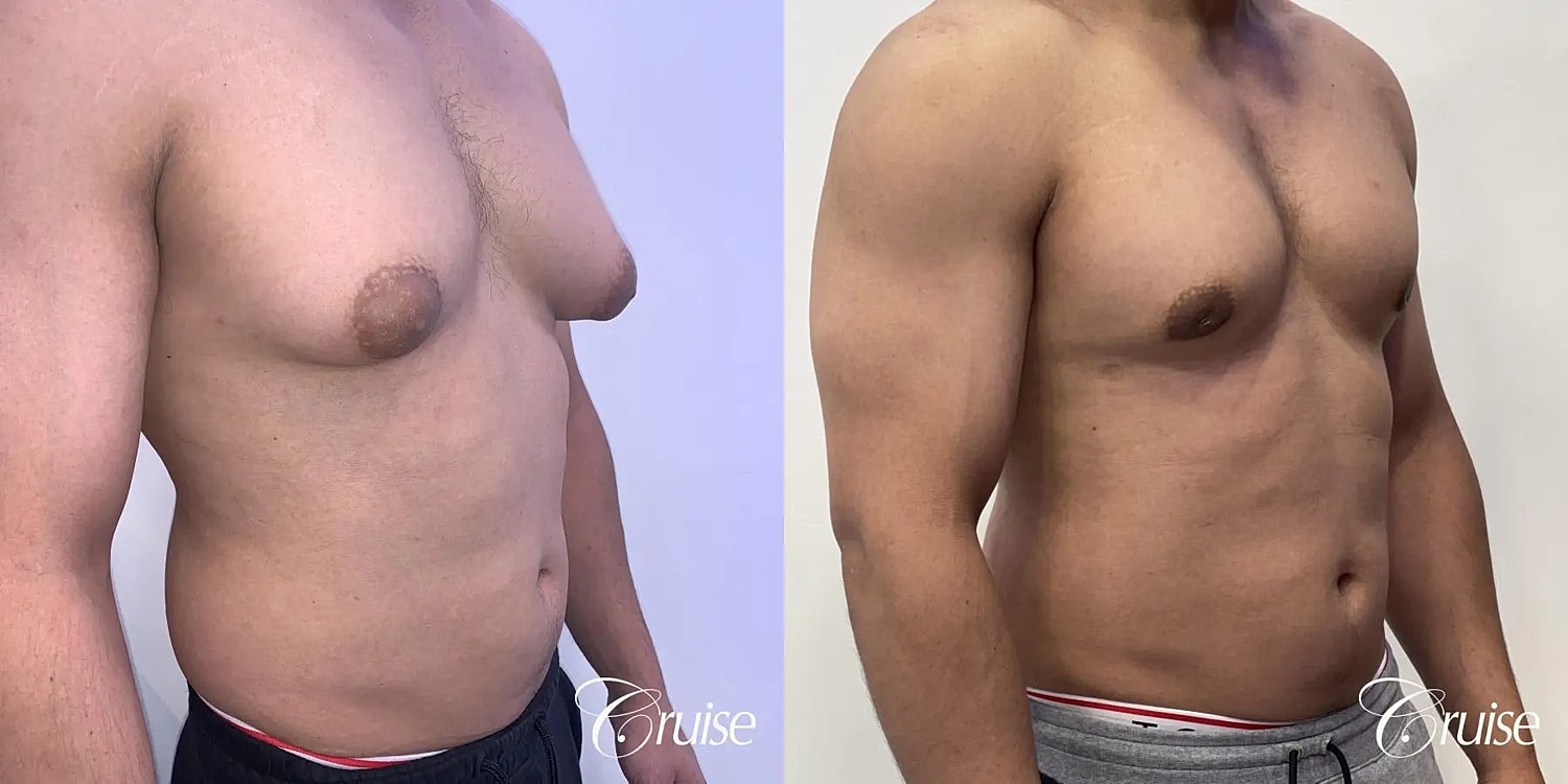Gynecomastia Surgery Before & After