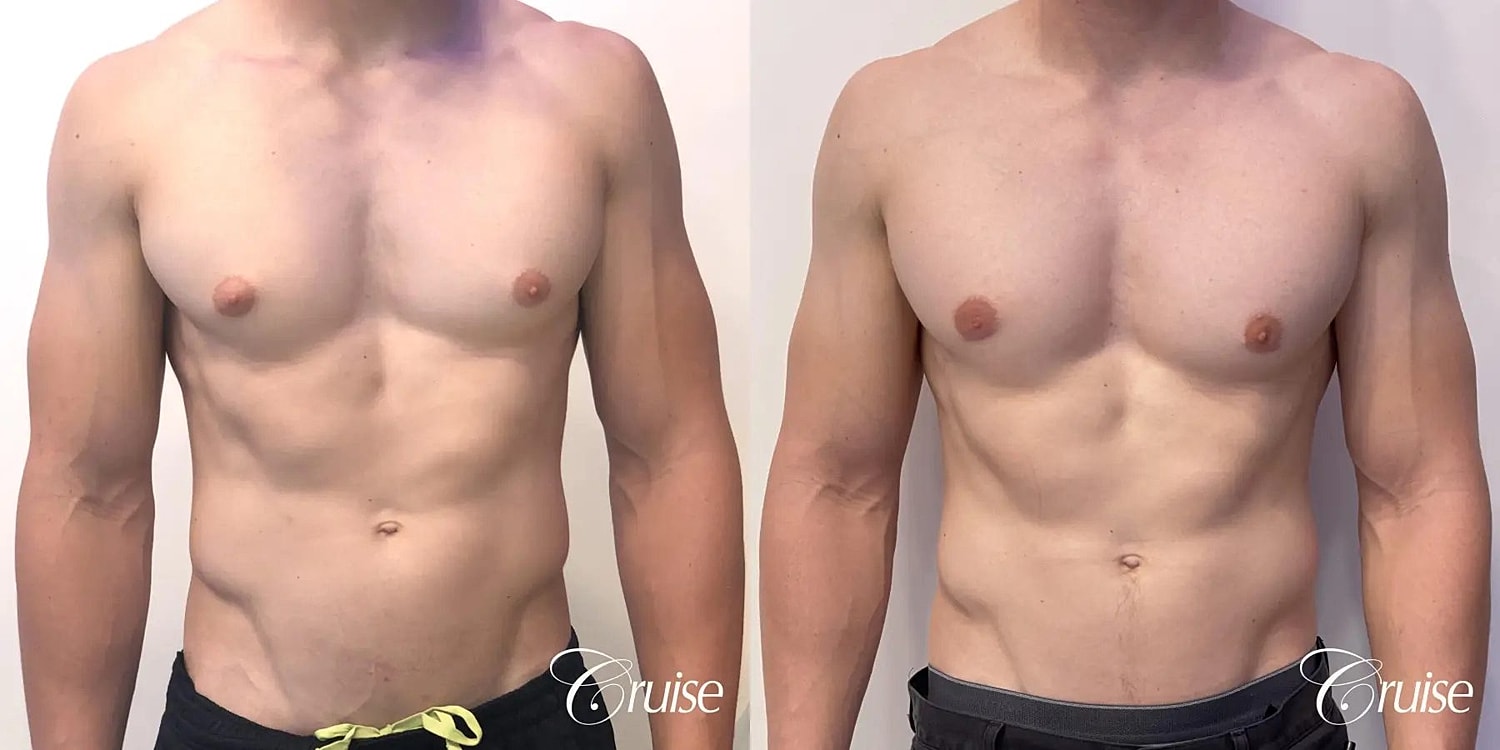 Gynecomastia Surgery Before & After