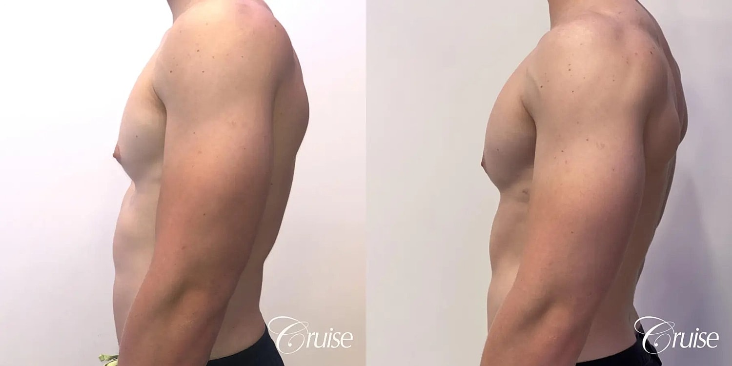 Gynecomastia Surgery Before & After