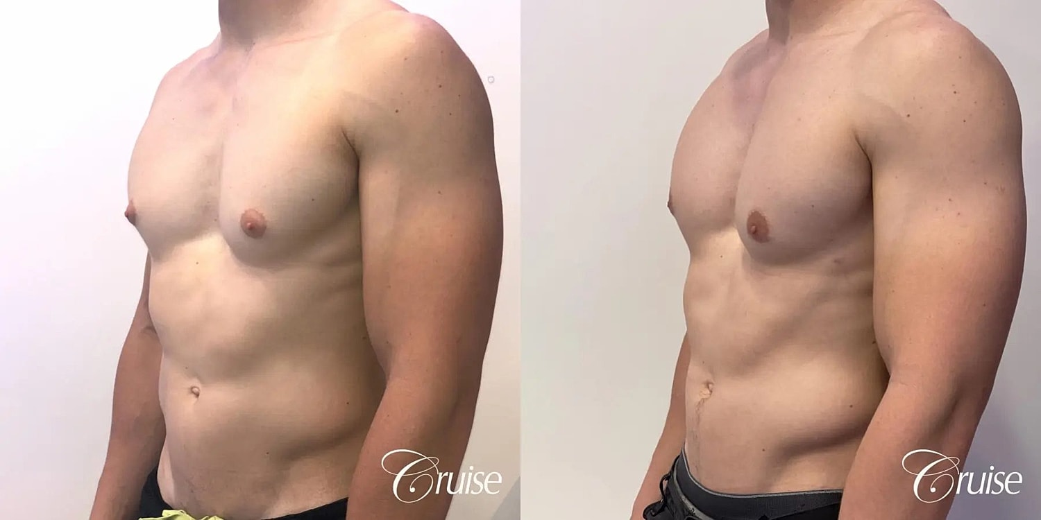 Gynecomastia Surgery Before & After