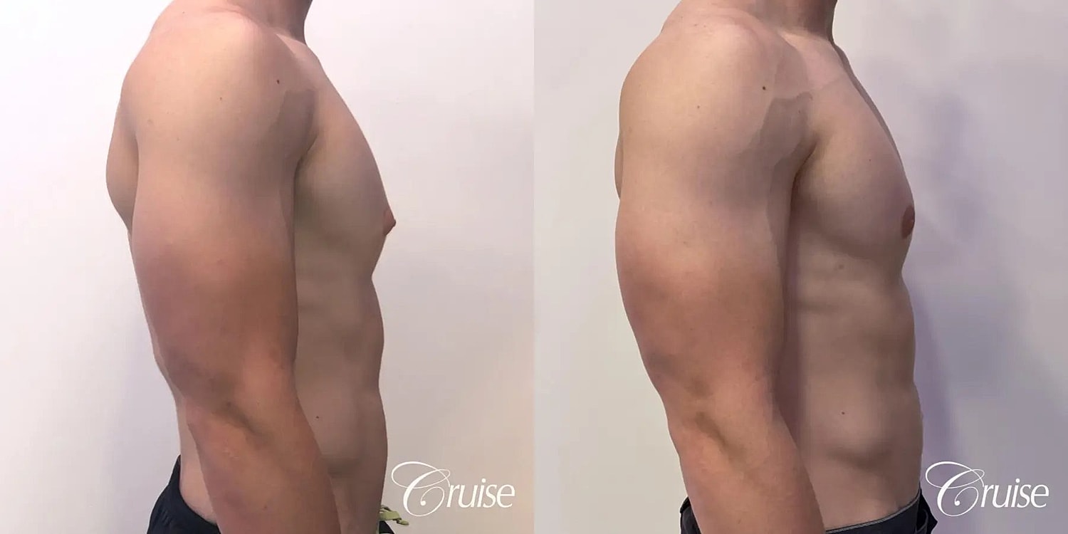 Gynecomastia Surgery Before & After