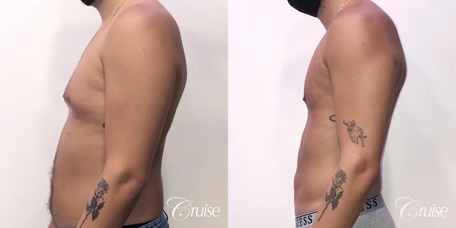 Gynecomastia Surgery Before & After