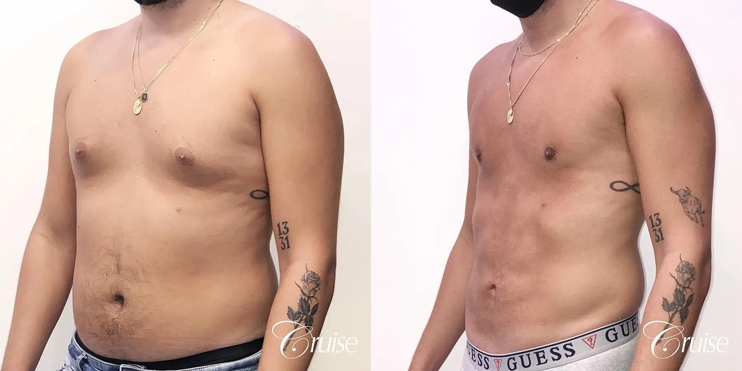 Gynecomastia Surgery Before & After