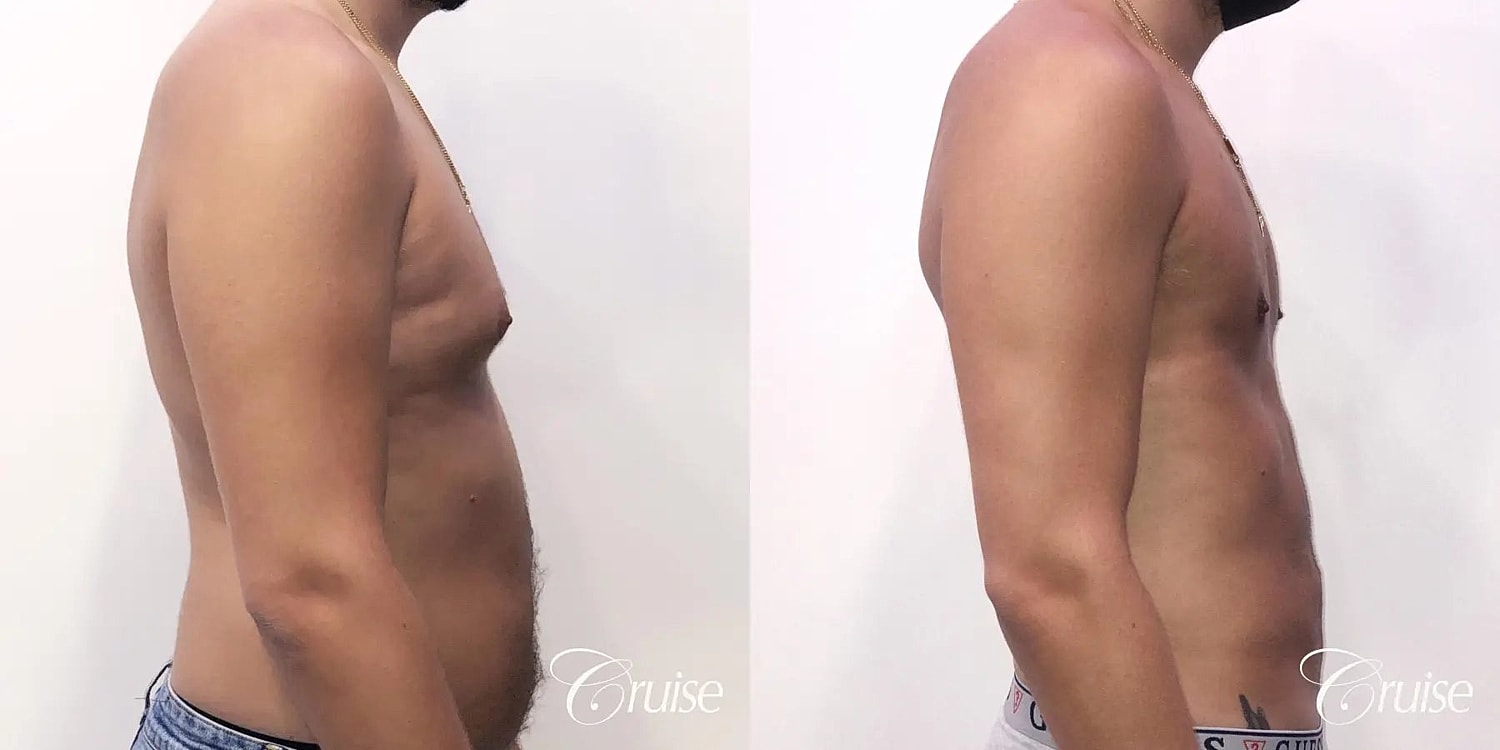Gynecomastia Surgery Before & After