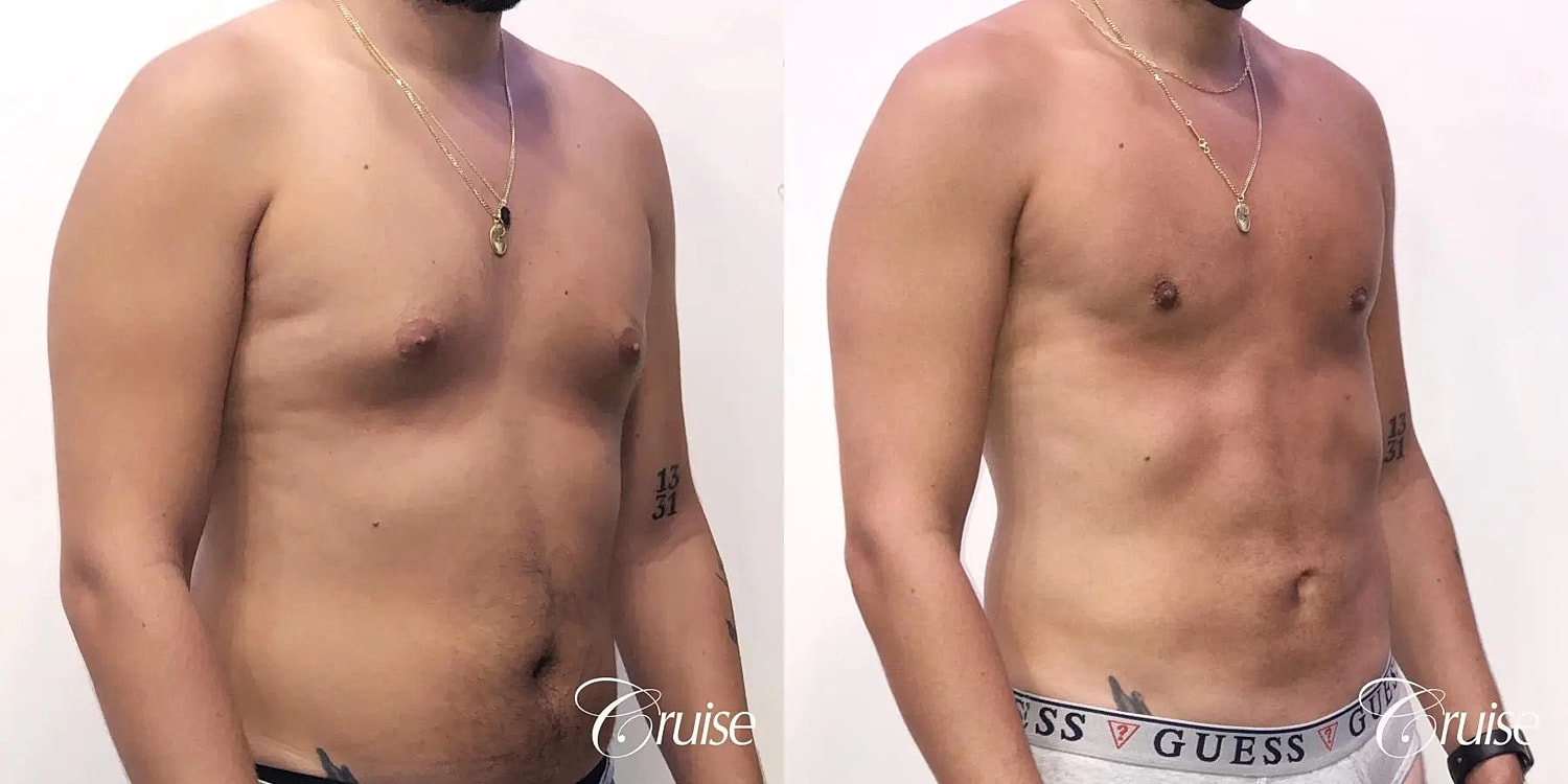 Gynecomastia Surgery Before & After