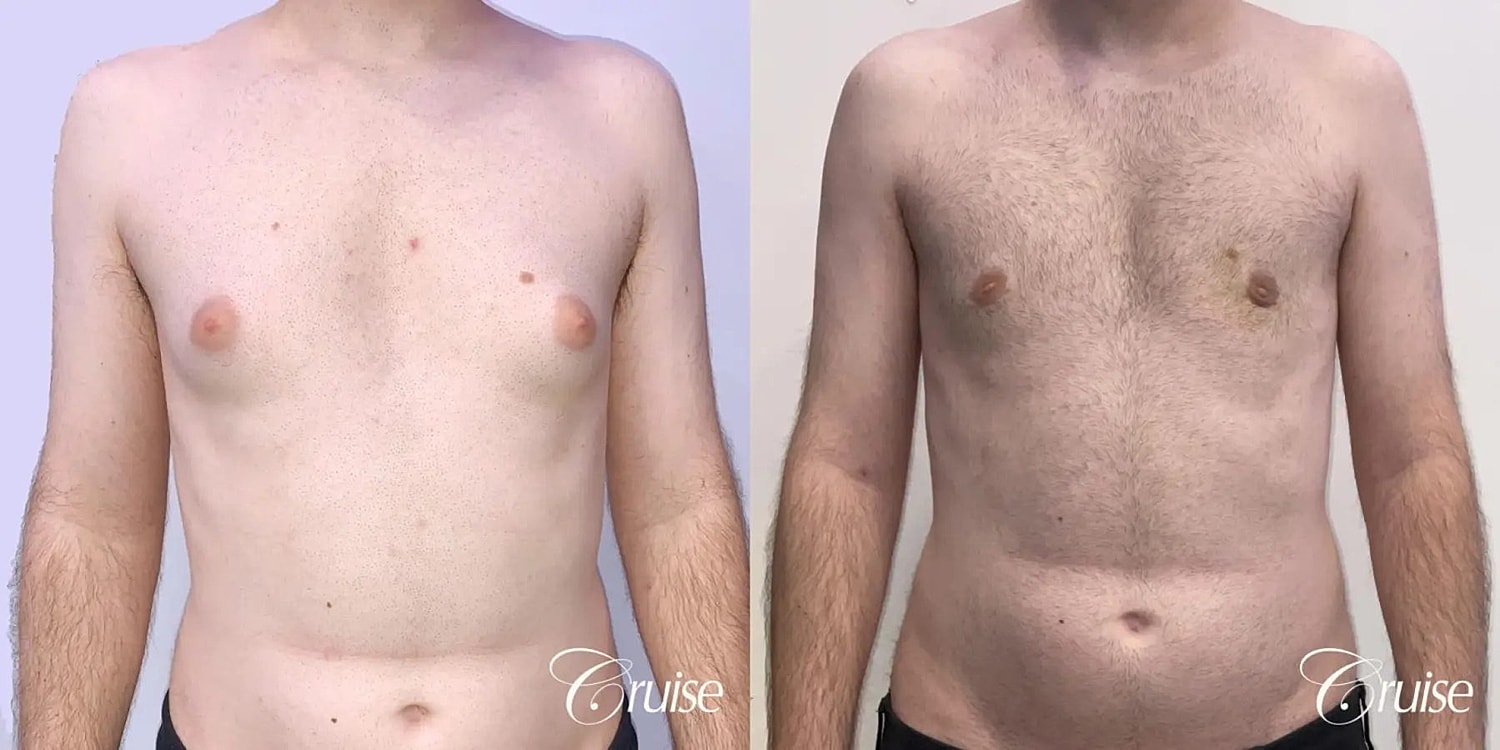 Gynecomastia Surgery Before & After
