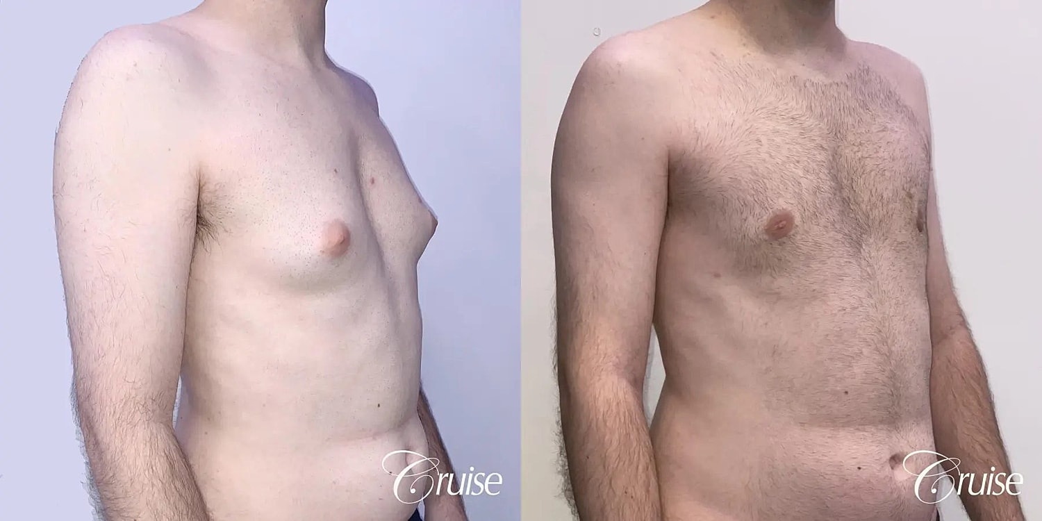 Gynecomastia Surgery Before & After
