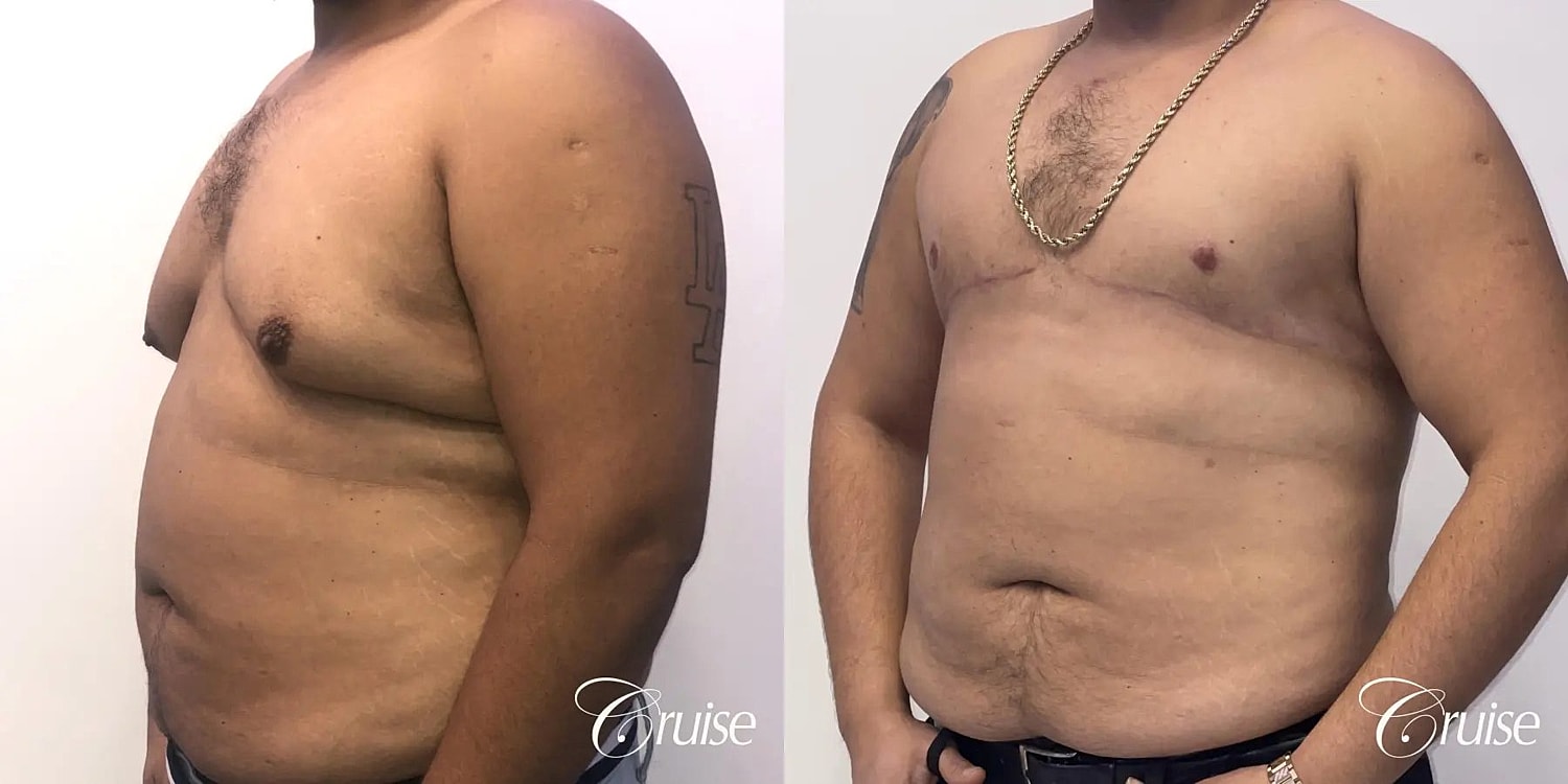 Gynecomastia Surgery Before & After