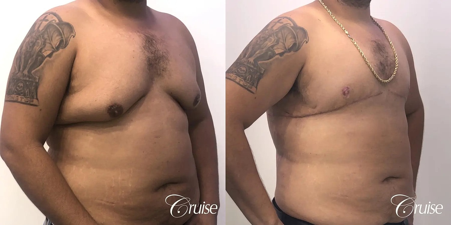 Gynecomastia Surgery Before & After