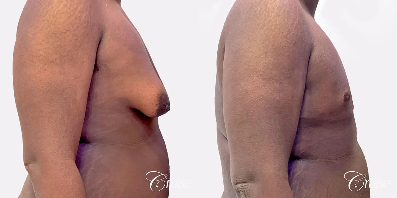 Gynecomastia Surgery Before & After