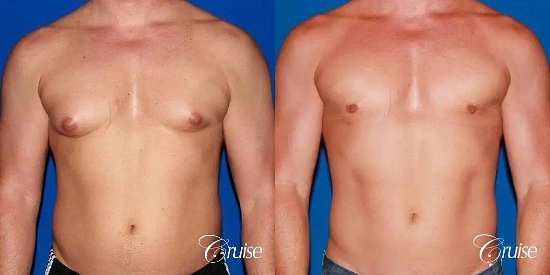 Gynecomastia Surgery Before & After