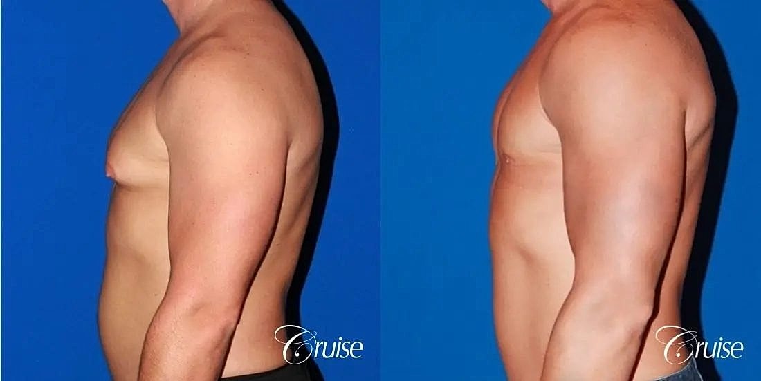 Gynecomastia Surgery Before & After