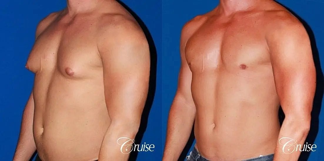 Gynecomastia Surgery Before & After