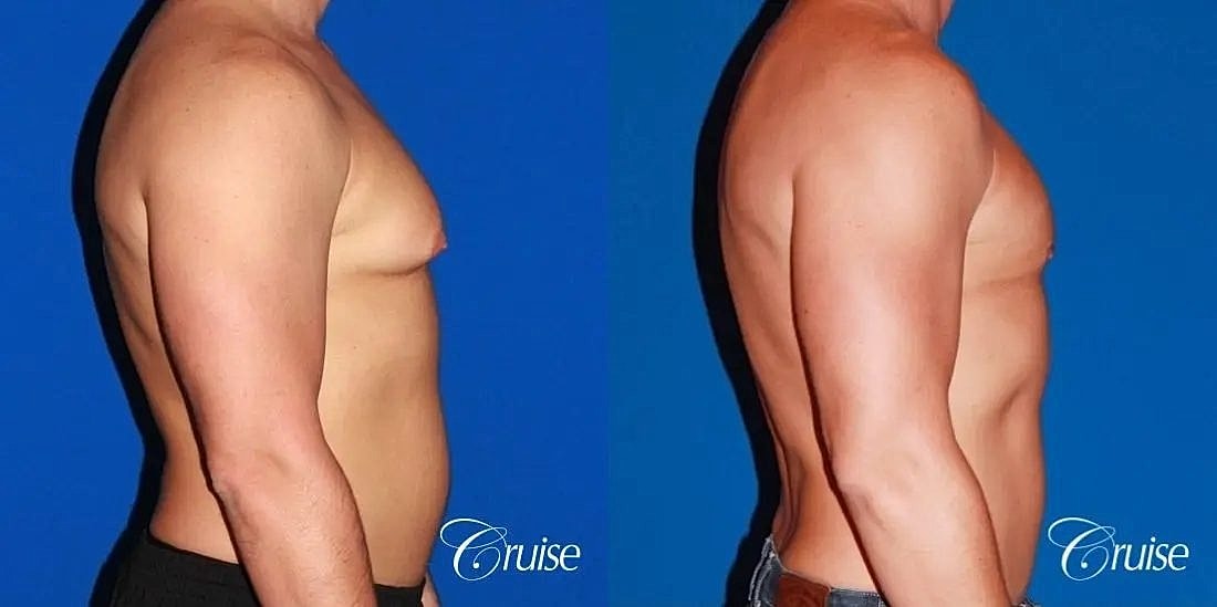 Gynecomastia Surgery Before & After
