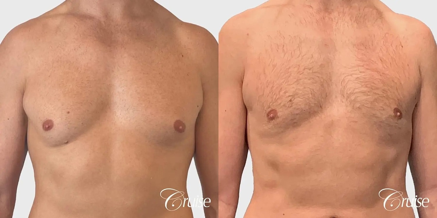 Gynecomastia Surgery Before & After