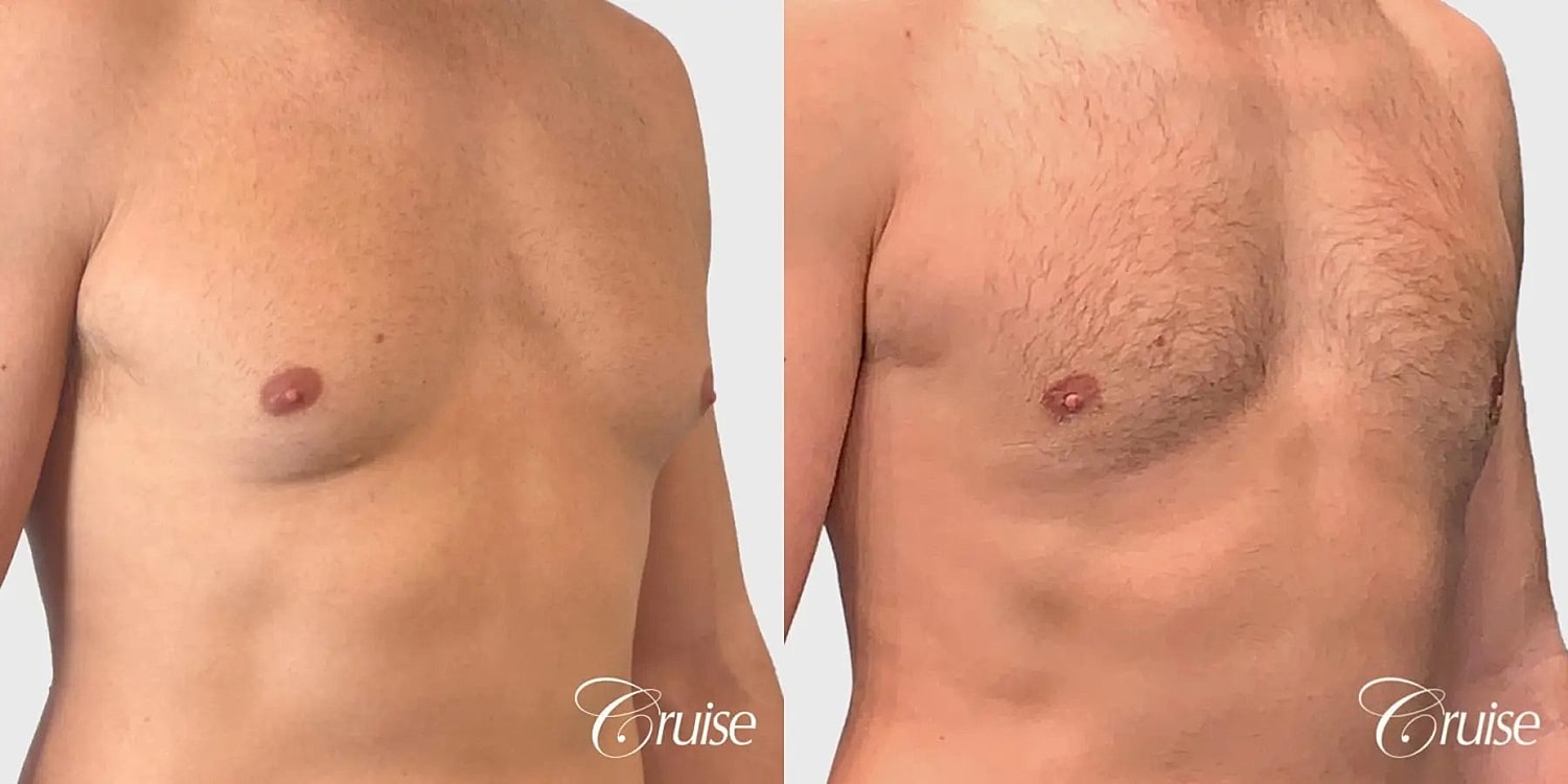 Gynecomastia Surgery Before & After