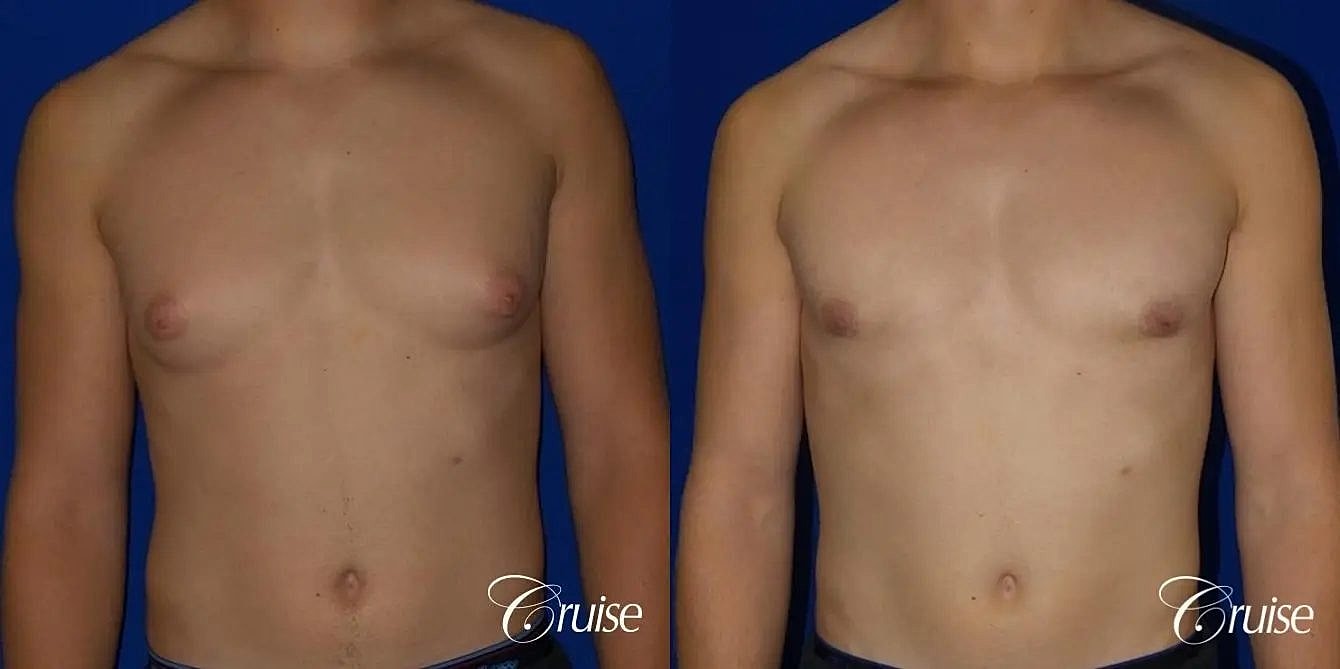Gynecomastia Surgery Before & After