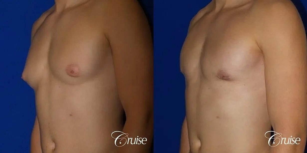 Gynecomastia Surgery Before & After