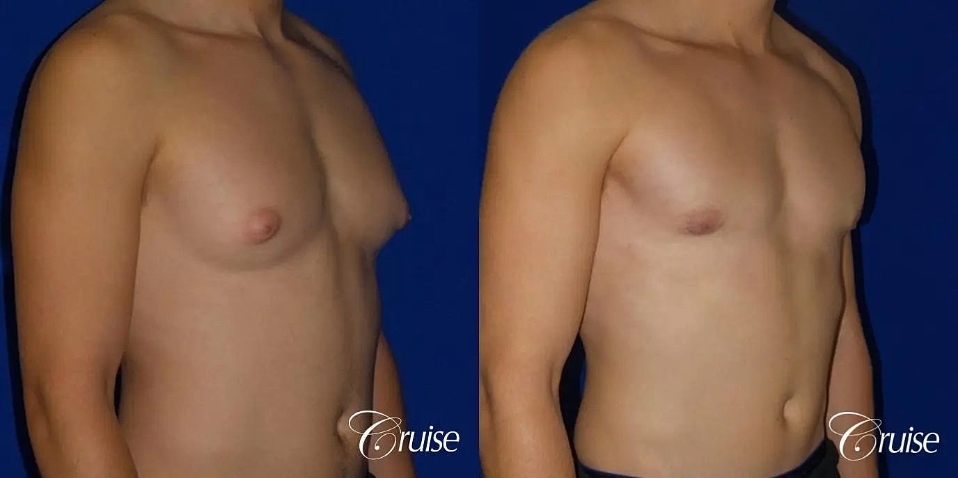 Gynecomastia Surgery Before & After