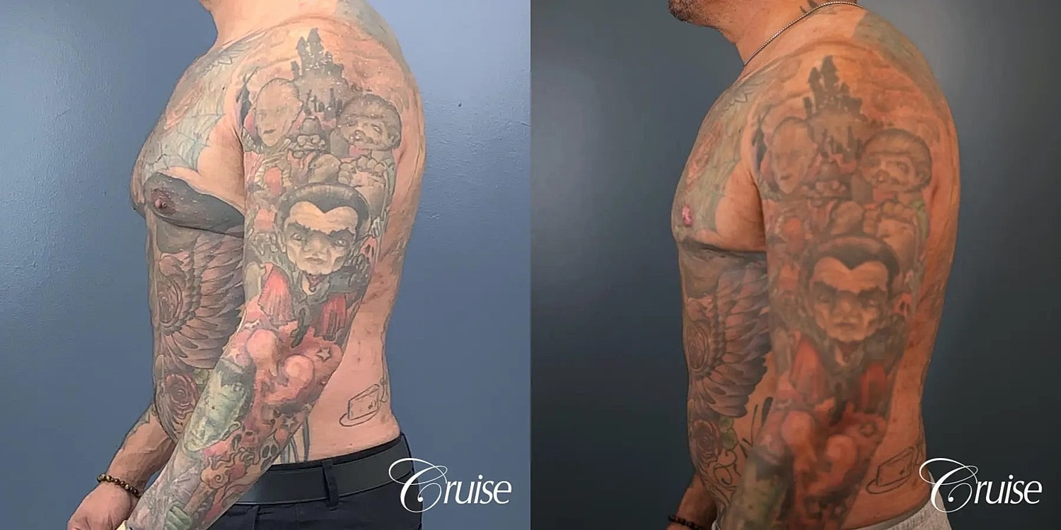 Gynecomastia Surgery Before & After