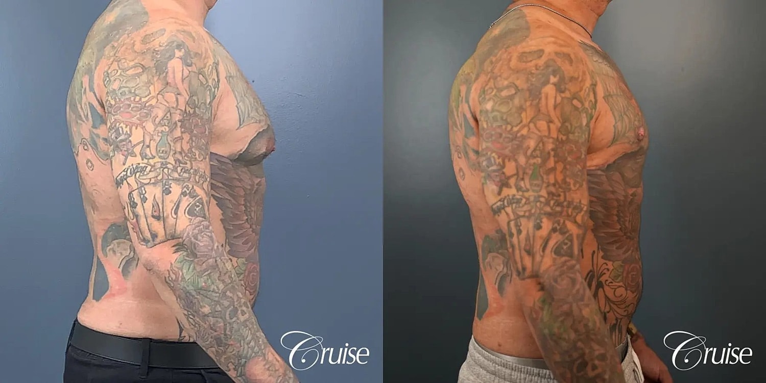 Gynecomastia Surgery Before & After