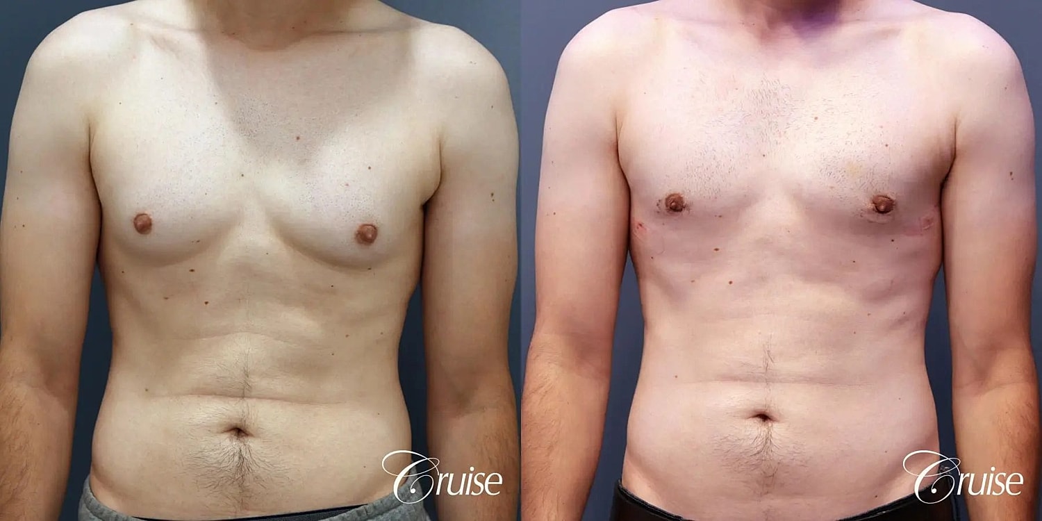 Gynecomastia Surgery Before & After
