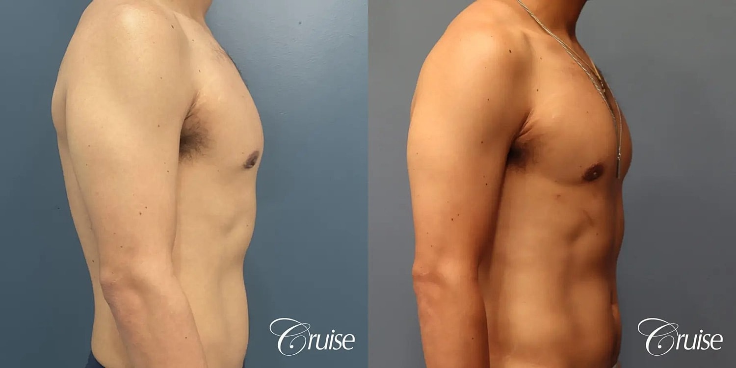 Gynecomastia Surgery Before & After